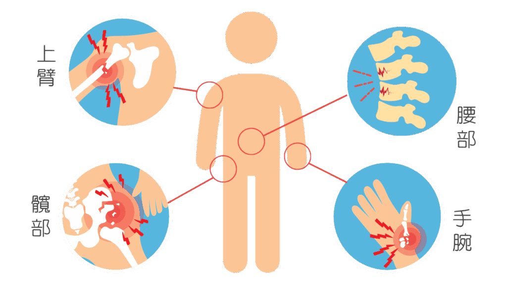 容易骨折的 4 大部位。維持骨質密度才能預防骨折。
