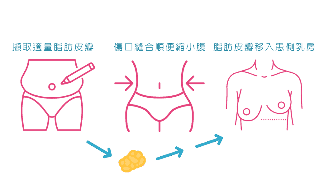 深下腹動脈穿通支皮瓣乳房重建手術流程