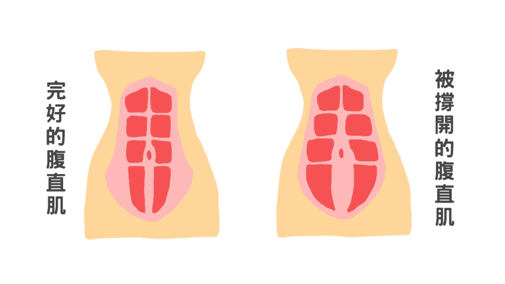 後期可能會有腹直肌分離。可請物理治療師帶些針對腹部的孕婦運動矯正。