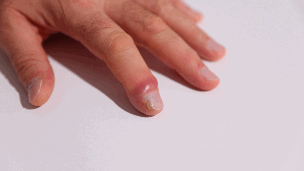 甲溝炎是吃標靶藥物的副作用之一。