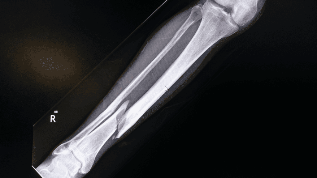 骨肉瘤患者僅輕微活動即可能導致骨折。